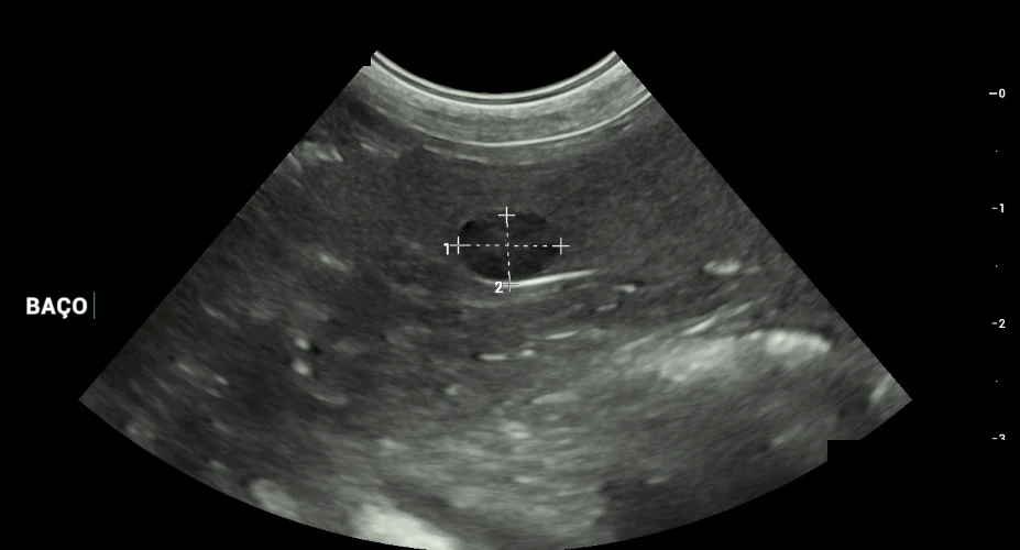 Imagem real de ultrassom abdominal, do jeito que o aparelho grava.
